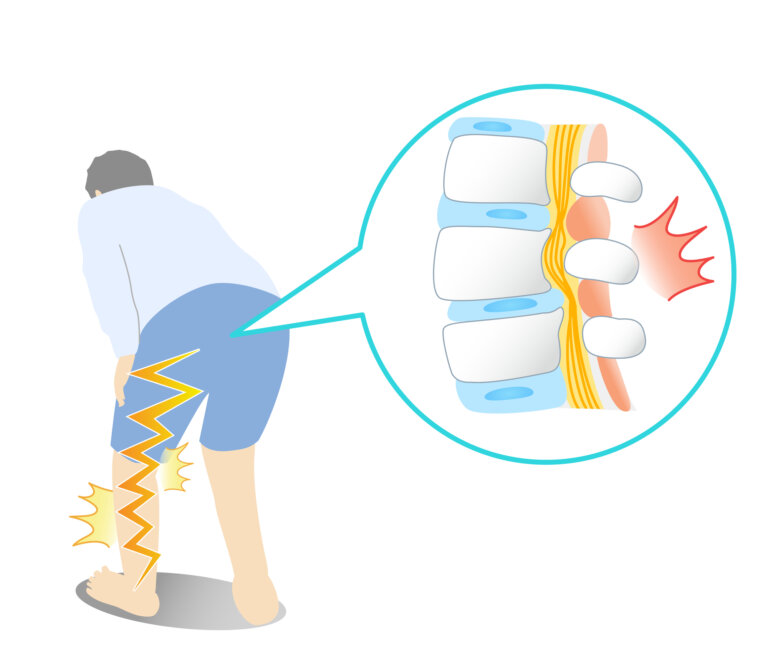 坐骨神経痛と診断される足腰の痛みしびれは、ミオンパシーで克服が可能です。