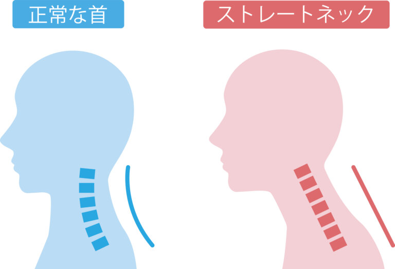ストレートネックによる首こり・肩こり・片頭痛は筋肉ロックリリースで改善が可能